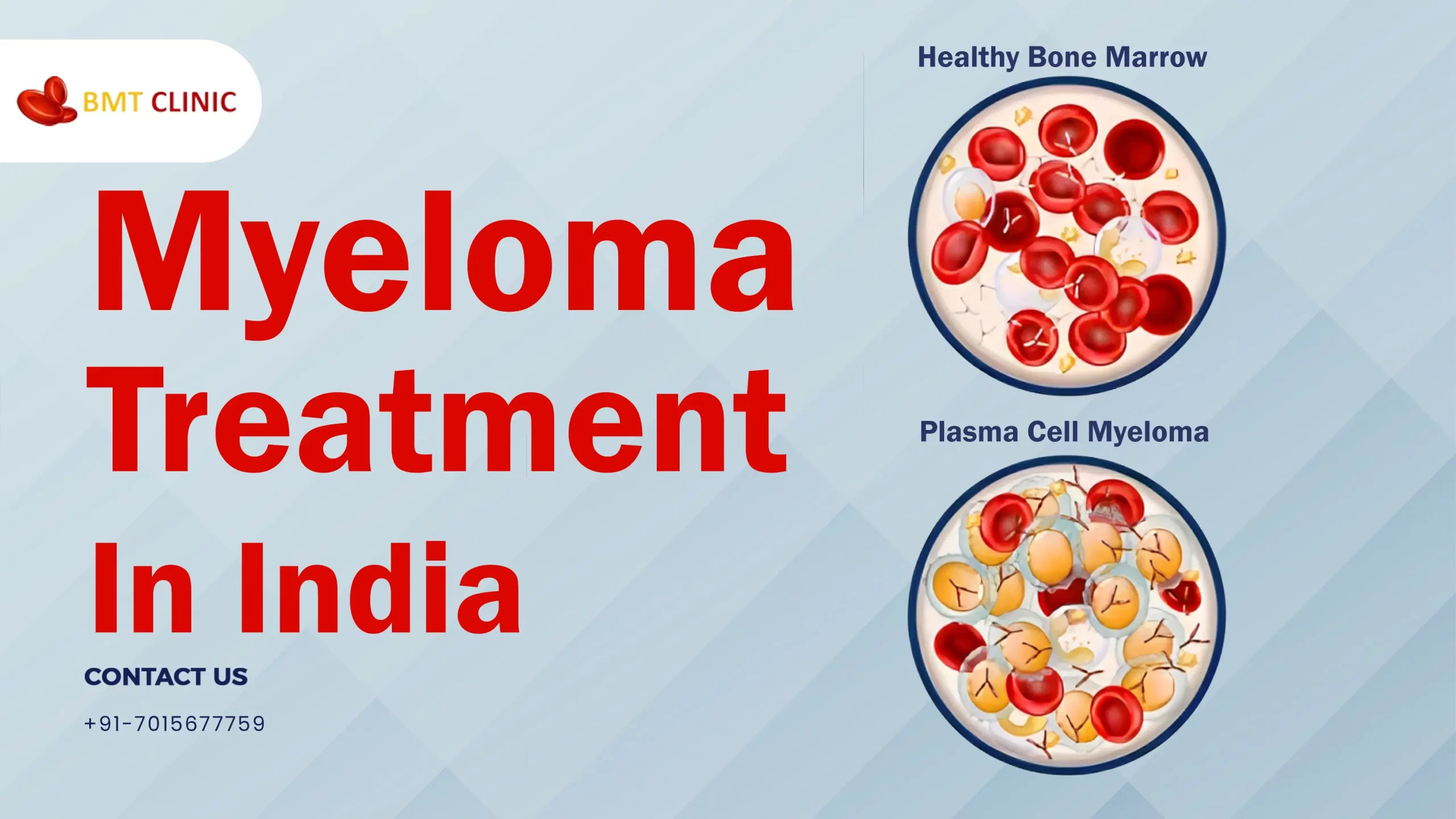 Myeloma Treatment Cost in India