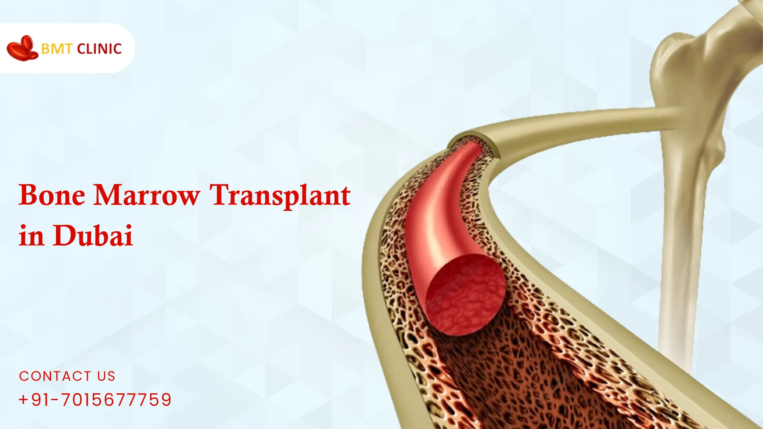 Bone Marrow Transplant Cost in Dubai