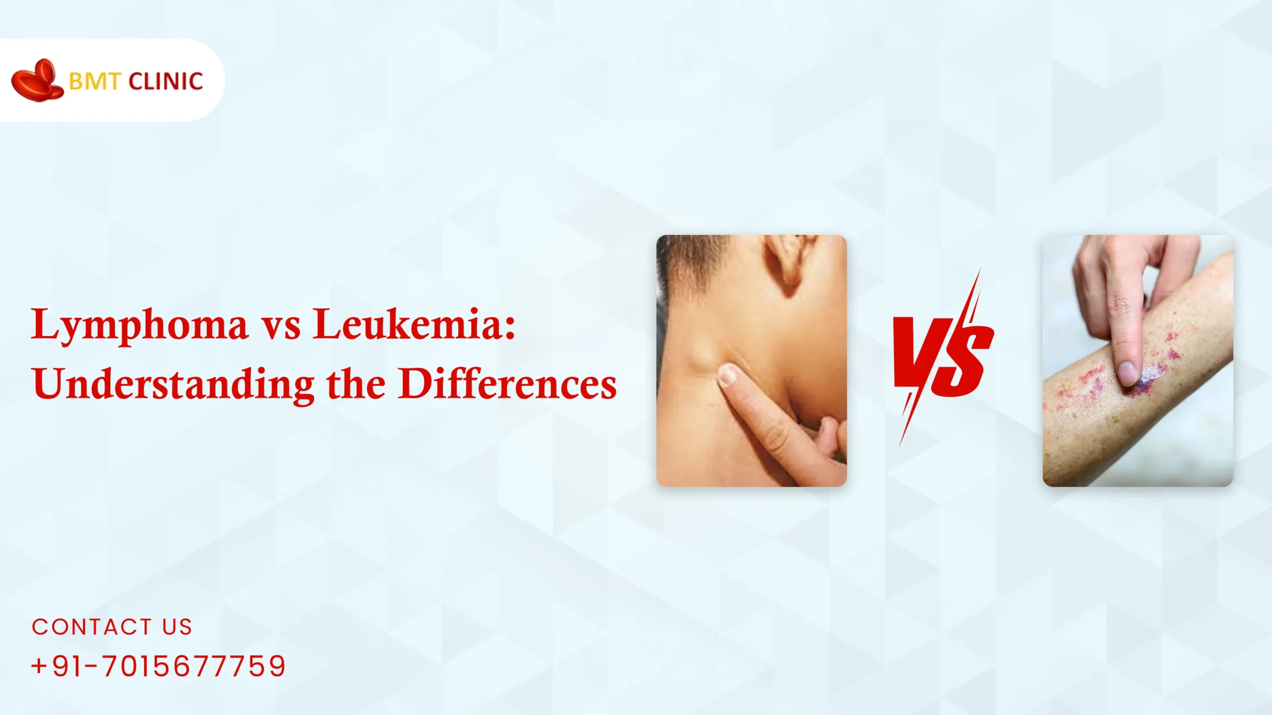 Lymphoma vs Leukemia