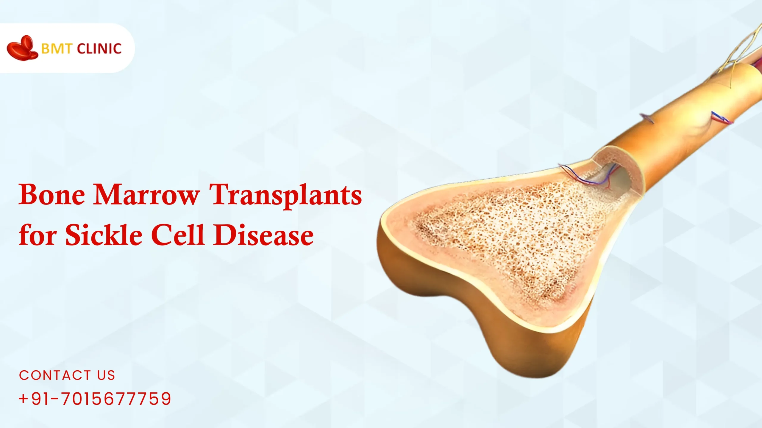 Bone Marrow Transplants for Sickle Cell Disease