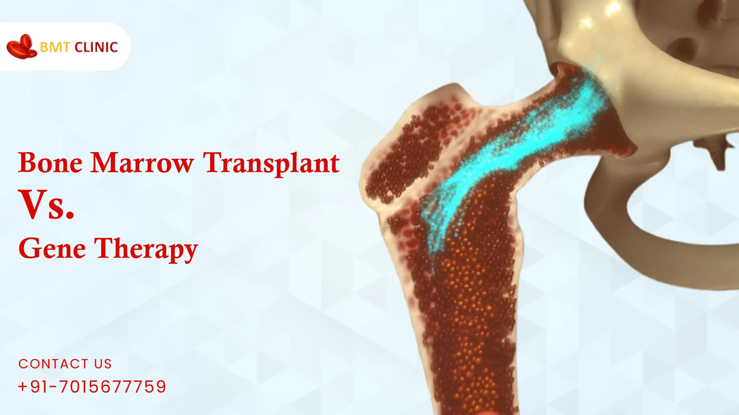 Bone Marrow Transplant Vs. Gene Therapy